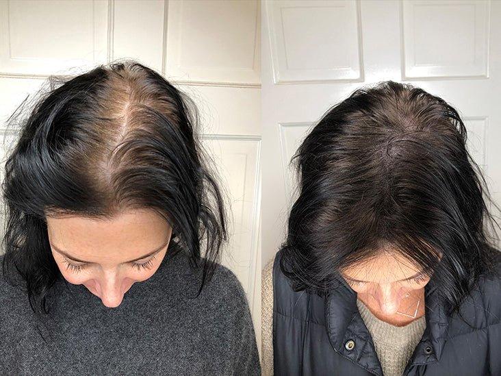 Hair Thinning vs Hair Loss - UPSCALP