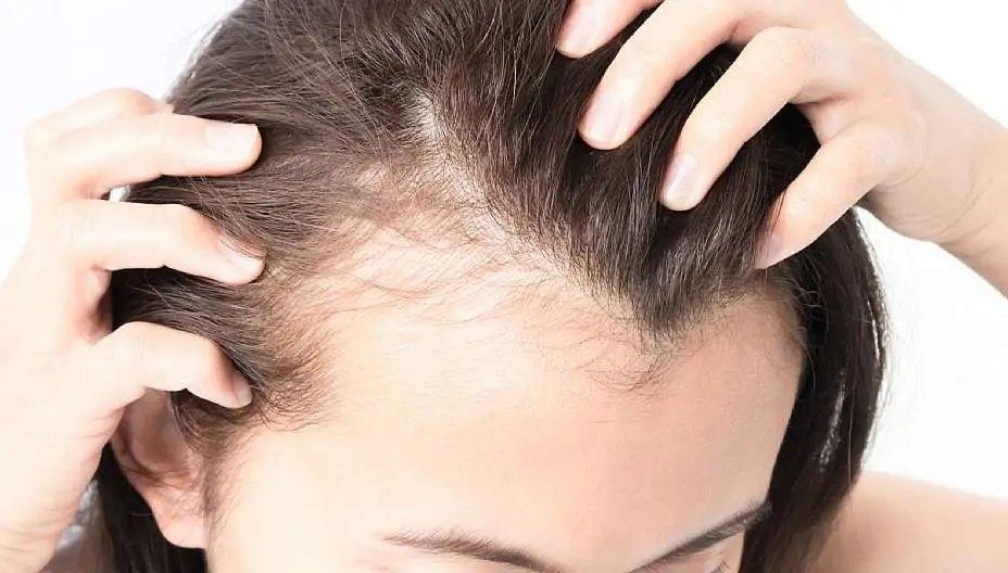 Understanding Alopecia: Causes, Types, and Treatments - UPSCALP